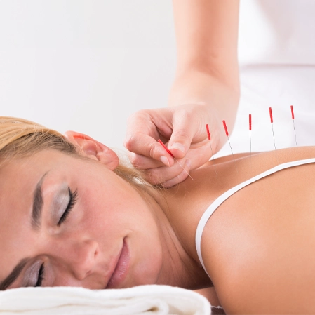 Chiropractic Firestone CO Woman Receiving Acupuncture