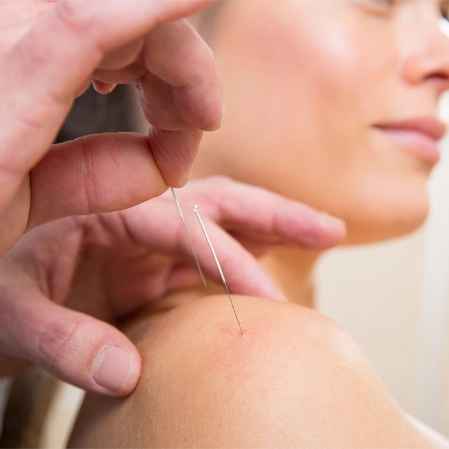 Chiropractic Firestone CO Woman Receiving Dry Needling